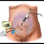 Diagnostic Laproscopy