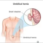 Umbilical Hernia