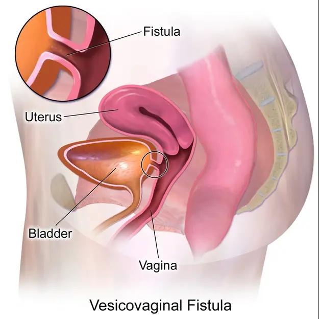 Fistula