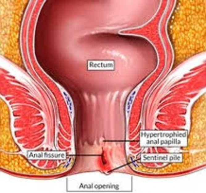 Fissure