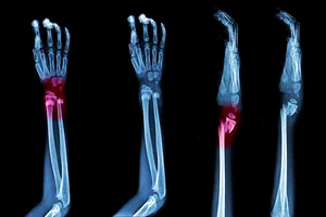 Complex Trauma and Fracture Management